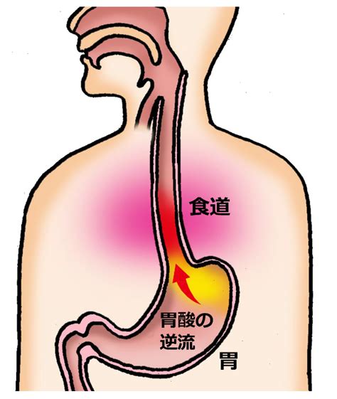 胃潰瘍 胃 食道 逆流